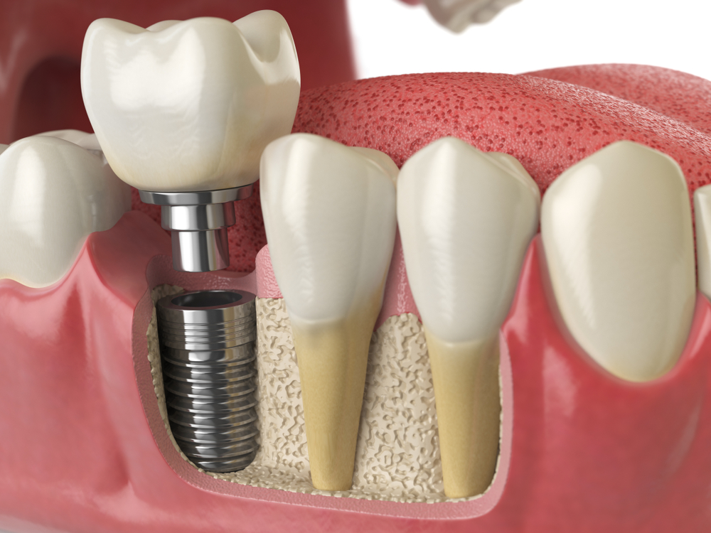 Dallas Dental Implant