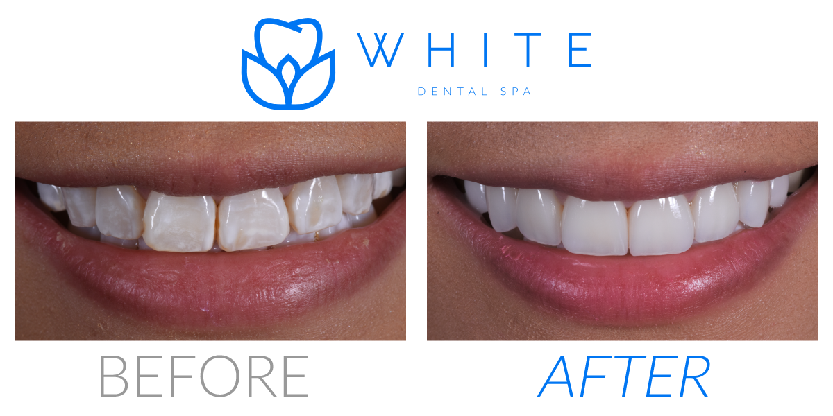 Dental Veneers in Dallas 75219 White Dental Spa